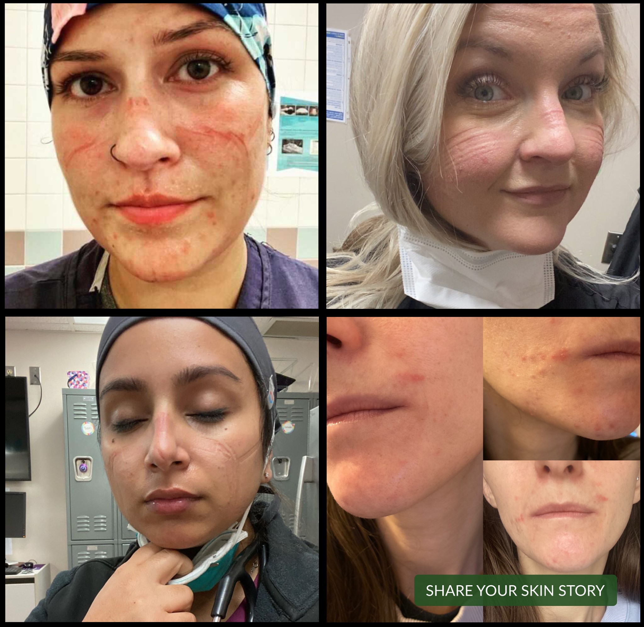 skin irritation from face masks