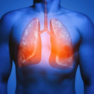 Bronchiectasis