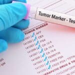 Tumour Markers